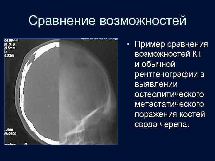Сравнение возможностей • Пример сравнения возможностей КТ и обычной рентгенографии в выявлении остеолитического метастатического