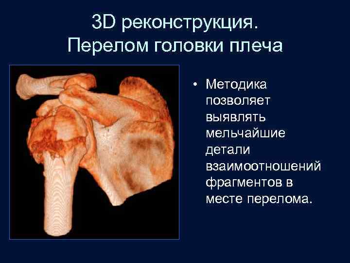 3 D реконструкция. Перелом головки плеча • Методика позволяет выявлять мельчайшие детали взаимоотношений фрагментов