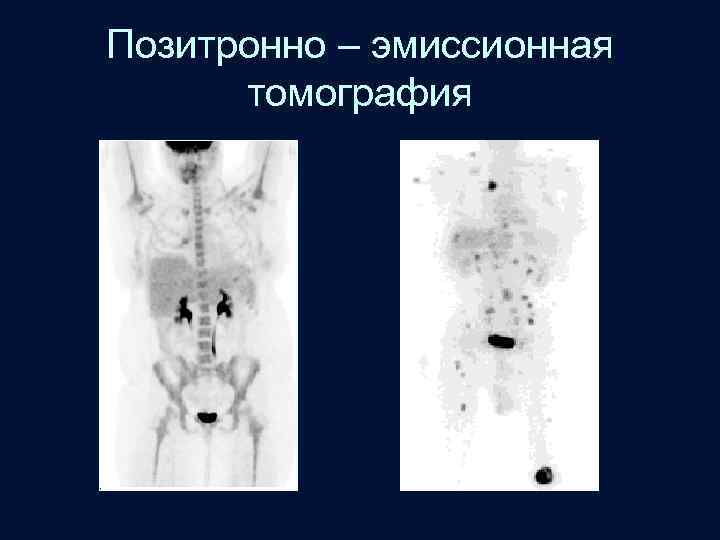 Позитронно – эмиссионная томография 