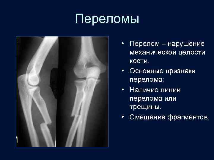 Переломы • Перелом – нарушение механической целости кости. • Основные признаки перелома: • Наличие