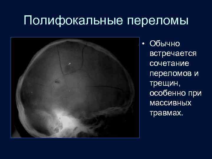 Полифокальные переломы • Обычно встречается сочетание переломов и трещин, особенно при массивных травмах. 