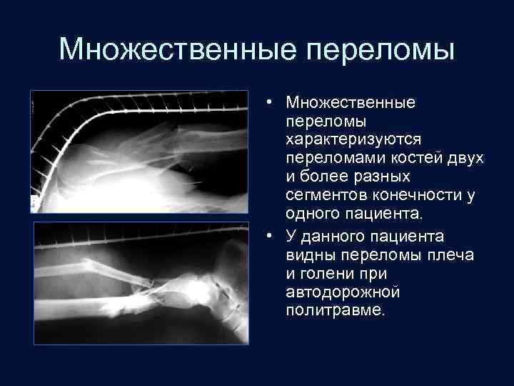 Множественные переломы • Множественные переломы характеризуются переломами костей двух и более разных сегментов конечности