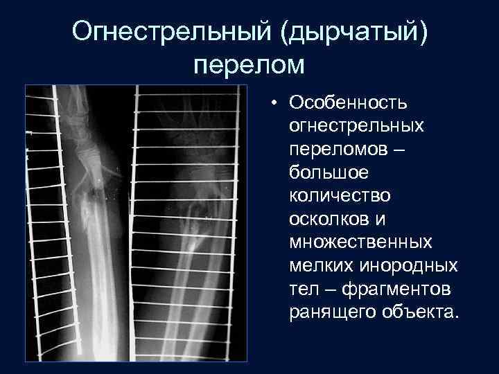 Огнестрельный (дырчатый) перелом • Особенность огнестрельных переломов – большое количество осколков и множественных мелких