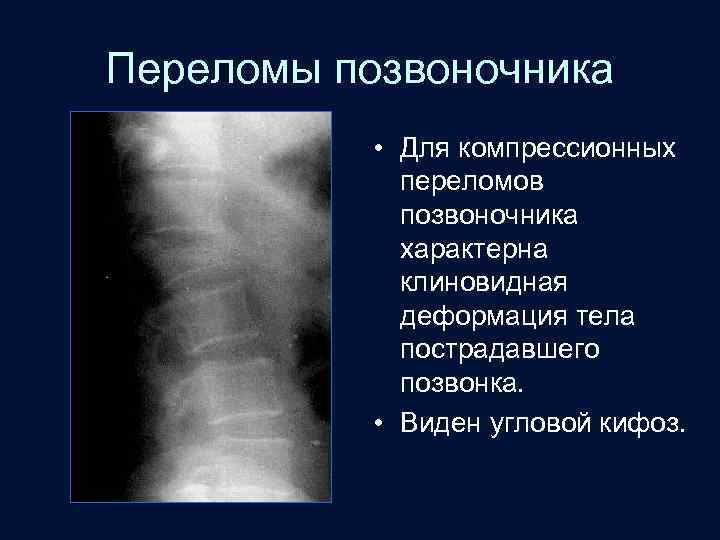 Лучевая диагностика позвоночник презентация