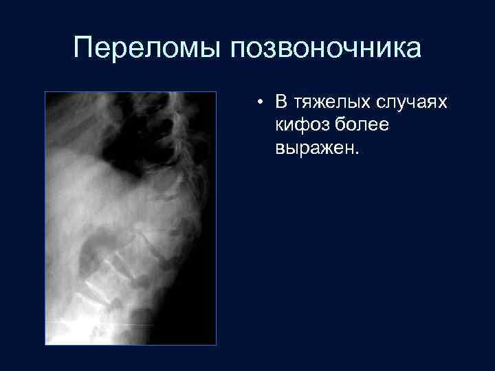 Переломы позвоночника • В тяжелых случаях кифоз более выражен. 