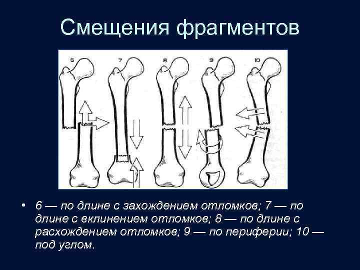 Смещения фрагментов • 6 — по длине с захождением отломков; 7 — по длине