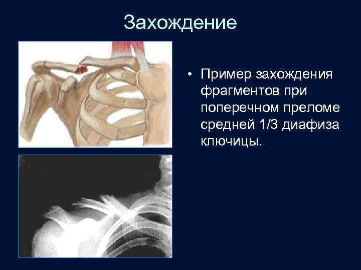 Захождение • Пример захождения фрагментов при поперечном преломе средней 1/3 диафиза ключицы. 