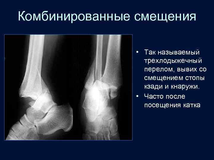 Комбинированные смещения • Так называемый трехлодыжечный перелом, вывих со смещением стопы кзади и кнаружи.