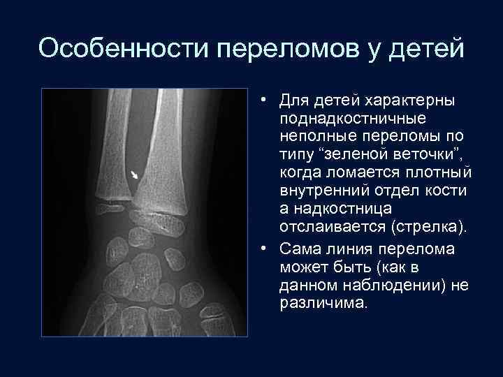 Особенности переломов у детей • Для детей характерны поднадкостничные неполные переломы по типу “зеленой