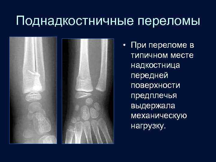 Поднадкостничные переломы • При переломе в типичном месте надкостница передней поверхности предплечья выдержала механическую
