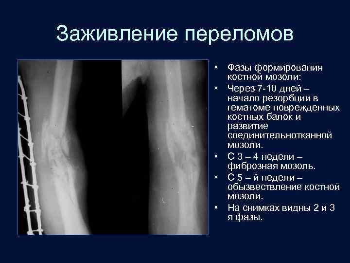 Заживление переломов • Фазы формирования костной мозоли: • Через 7 -10 дней – начало