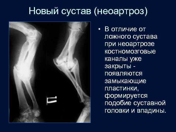 Новый сустав (неоартроз) • В отличие от ложного сустава при неоартрозе костномозговые каналы уже