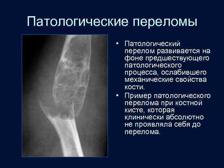 Патологические переломы • Патологический перелом развивается на фоне предшествующего патологического процесса, ослабившего механические свойства