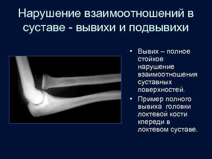 Нарушение взаимоотношений в суставе - вывихи и подвывихи • Вывих – полное стойкое нарушение