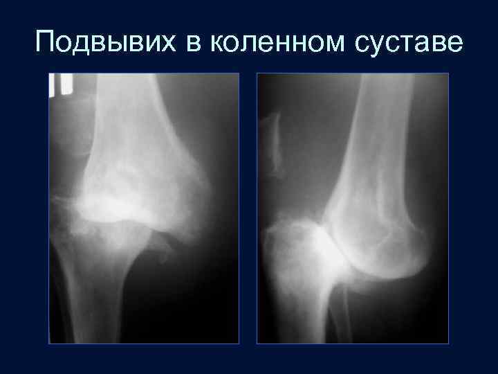 Подвывих в коленном суставе 