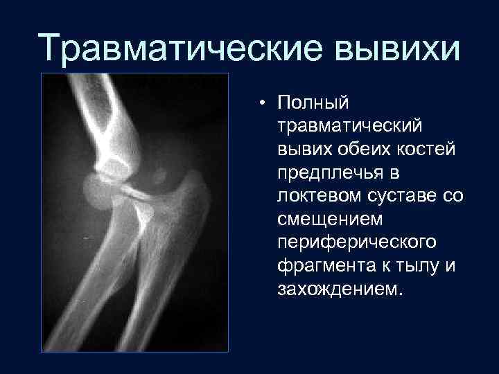 Травматические вывихи • Полный травматический вывих обеих костей предплечья в локтевом суставе со смещением