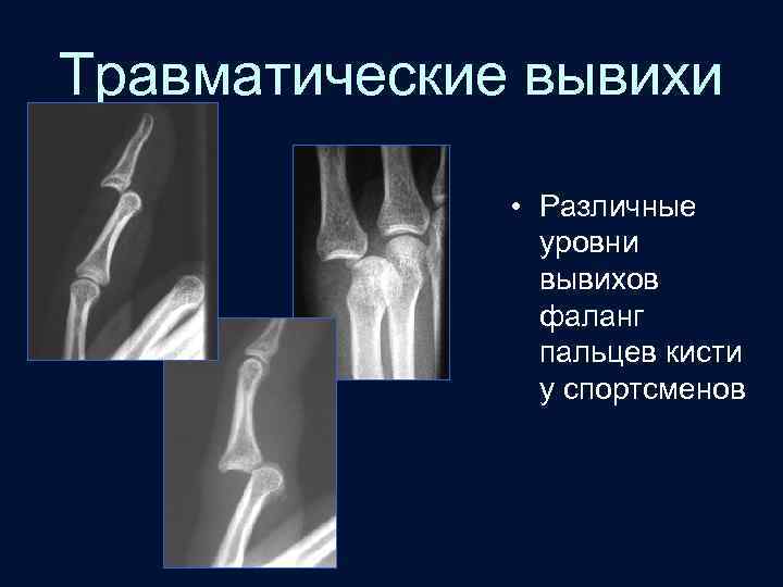 Травматические вывихи • Различные уровни вывихов фаланг пальцев кисти у спортсменов 