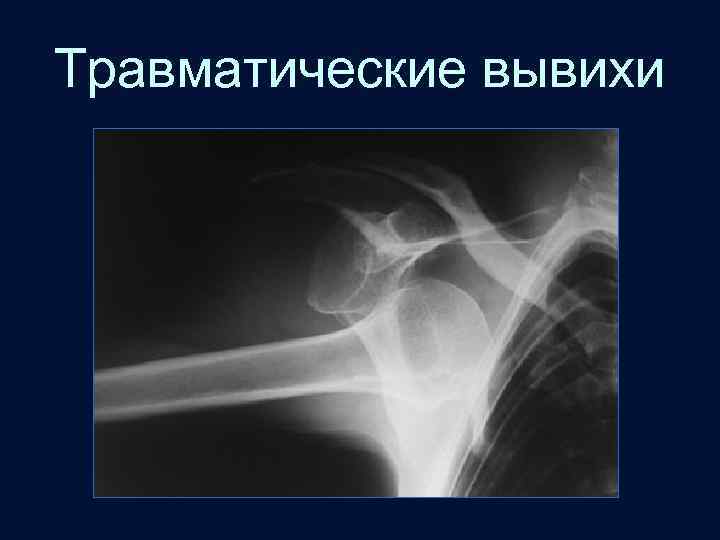 Травматические вывихи 