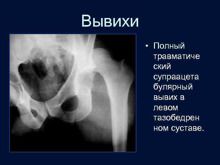 Вывихи • Полный травматиче ский супраацета булярный вывих в левом тазобедрен ном суставе. 