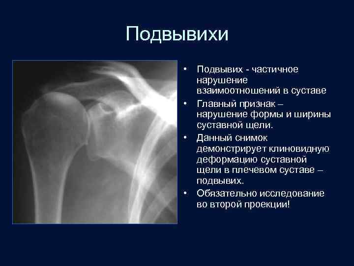 Подвывихи • Подвывих - частичное нарушение взаимоотношений в суставе • Главный признак – нарушение