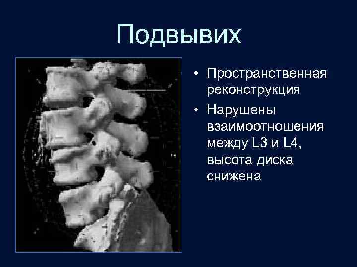 Подвывих • Пространственная реконструкция • Нарушены взаимоотношения между L 3 и L 4, высота