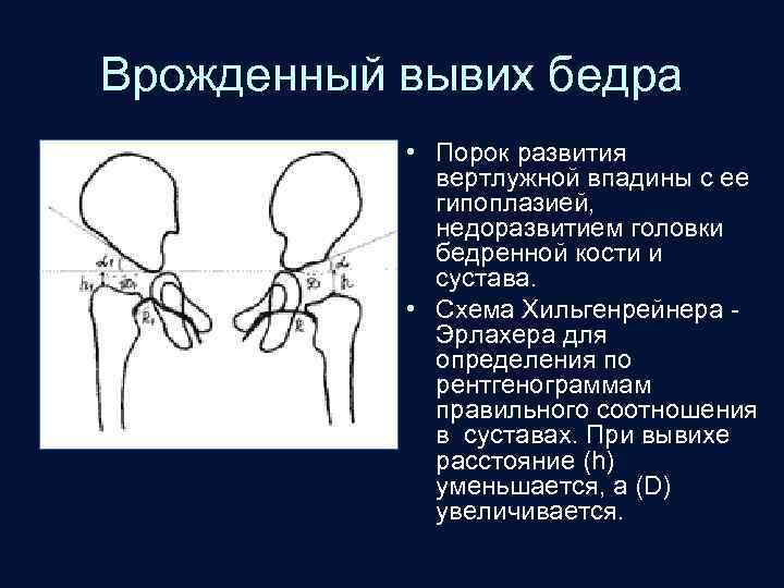 Врожденный вывих бедра • Порок развития вертлужной впадины с ее гипоплазией, недоразвитием головки бедренной