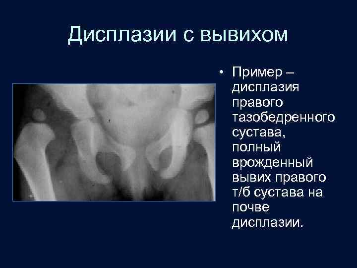 Дисплазии с вывихом • Пример – дисплазия правого тазобедренного сустава, полный врожденный вывих правого