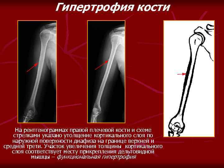 Гипертрофия кости На рентгенограммах правой плечевой кости и схеме стрелками указано утолщение кортикального слоя