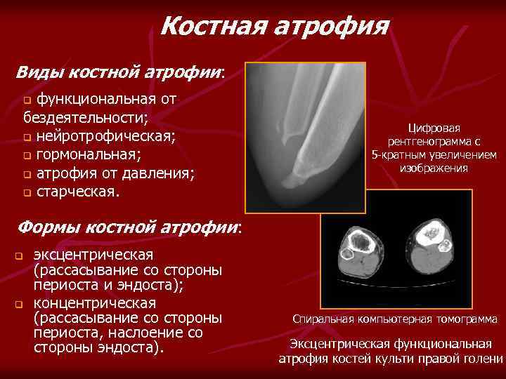 Костная атрофия Виды костной атрофии: функциональная от бездеятельности; q нейротрофическая; q гормональная; q атрофия