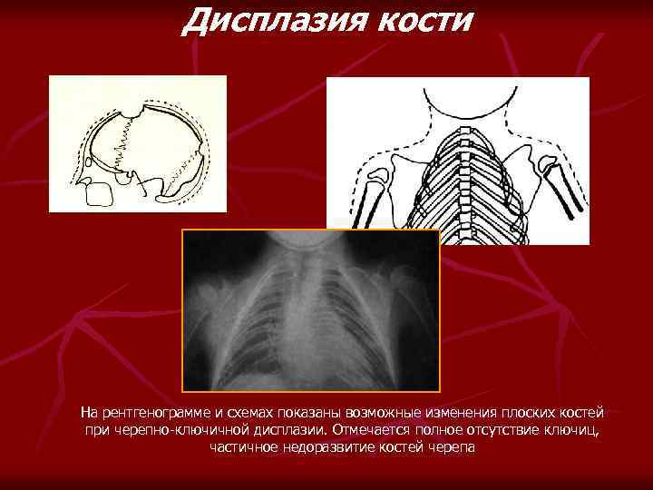 Дисплазия кости На рентгенограмме и схемах показаны возможные изменения плоских костей при черепно-ключичной дисплазии.