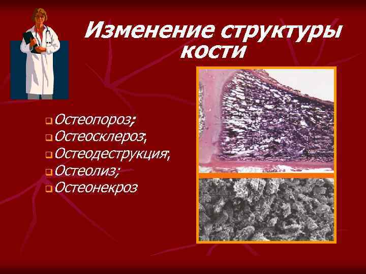 Изменение структуры кости Остеопороз; q. Остеосклероз; q. Остеодеструкция; q. Остеолиз; q. Остеонекроз q 