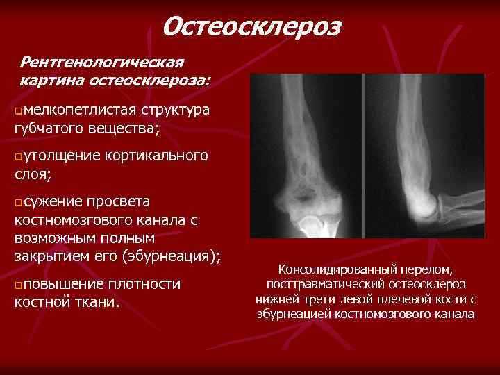 Остеосклероз Рентгенологическая картина остеосклероза: мелкопетлистая структура губчатого вещества; q утолщение кортикального слоя; q сужение