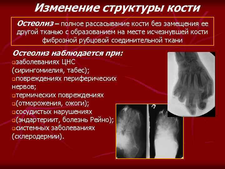 Изменение структуры кости Остеолиз – полное рассасывание кости без замещения ее другой тканью с
