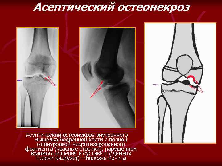 Асептический остеонекроз внутреннего мыщелка бедренной кости с полной отшнуровкой некротизированного фрагмента (красные стрелки), нарушением