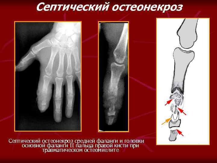 Септический остеонекроз средней фаланги и головки основной фаланги II пальца правой кисти при травматическом