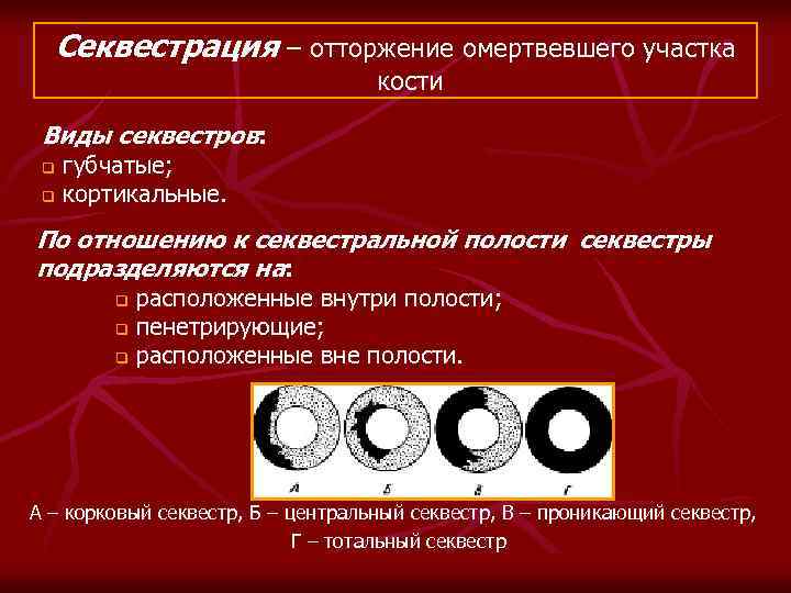 Секвестрация – отторжение омертвевшего участка кости Виды секвестров: q q губчатые; кортикальные. По отношению