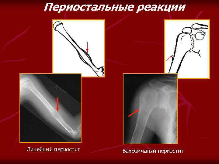 Периостальные реакции Линейный периостит Бахромчатый периостит 