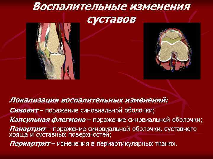 Воспалительные изменения суставов Локализация воспалительных изменений: Синовит – поражение синовиальной оболочки; Капсульная флегмона –