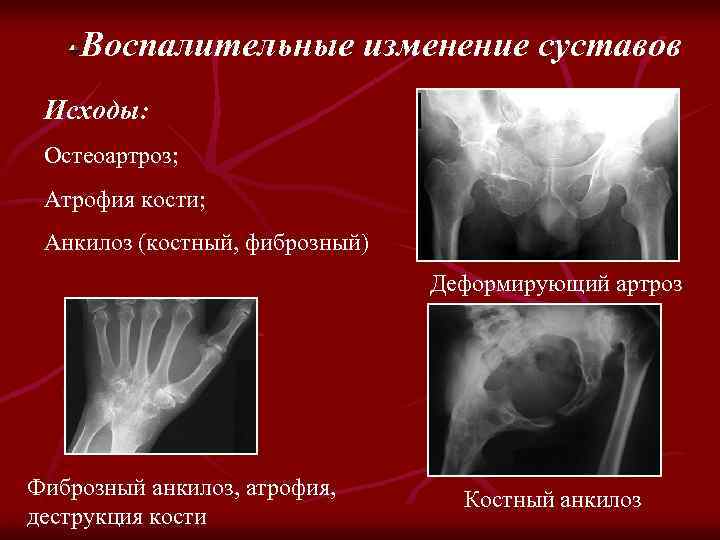 Воспалительные изменение суставов Исходы: Остеоартроз; Атрофия кости; Анкилоз (костный, фиброзный) Деформирующий артроз Фиброзный анкилоз,