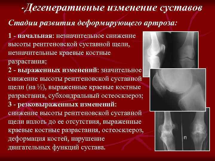 Дегенеративные изменение суставов Стадии развития деформирующего артроза: 1 - начальная: незначительное снижение высоты рентгеновской