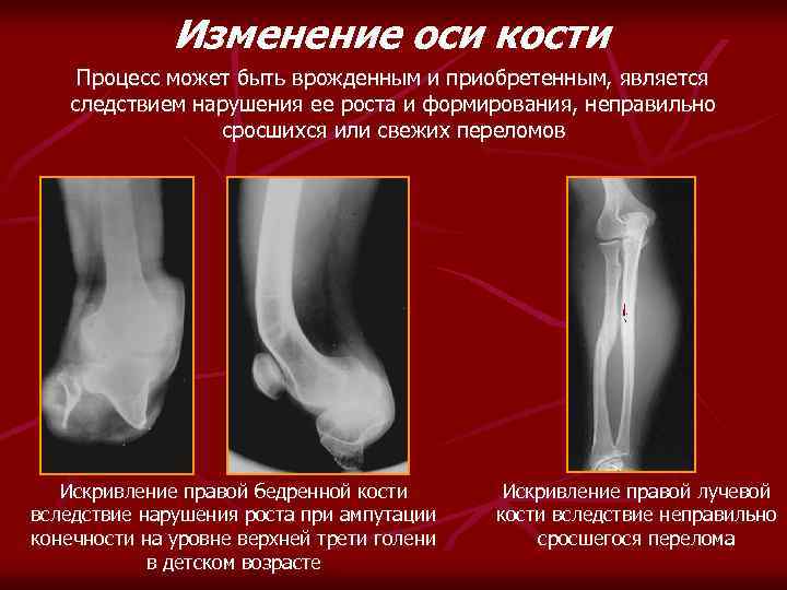 Изменение оси кости Процесс может быть врожденным и приобретенным, является следствием нарушения ее роста