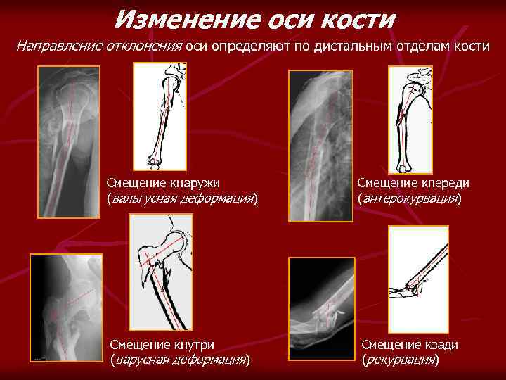 Изменение оси кости Направление отклонения оси определяют по дистальным отделам кости Смещение кнаружи (вальгусная