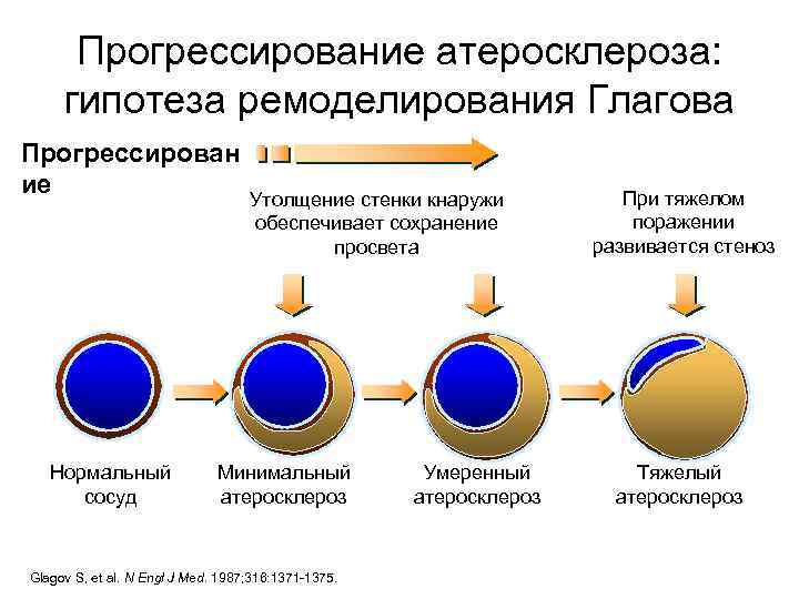 Прогрессирование атеросклероза: гипотеза ремоделирования Глагова Прогрессирован ие Нормальный сосуд Утолщение стенки кнаружи обеспечивает сохранение