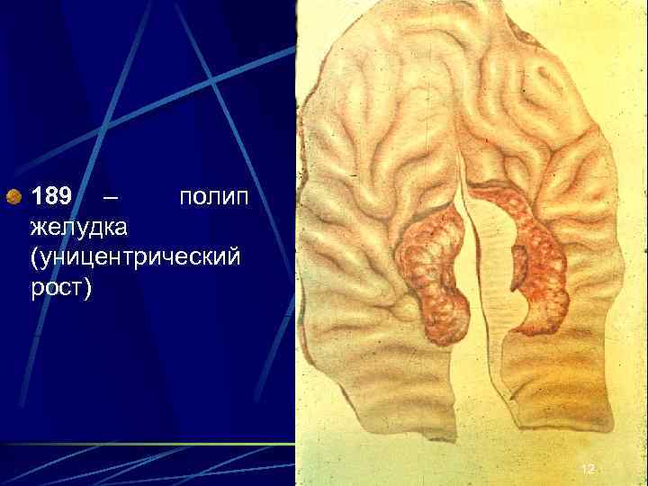 189 – полип желудка (уницентрический рост) 12 