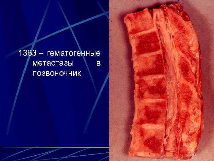 1363 – гематогенные метастазы в позвоночник 27 