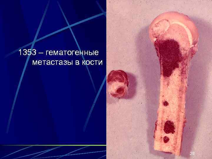 1353 – гематогенные метастазы в кости 28 