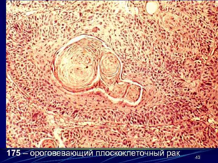 175 – ороговевающий плоскоклеточный рак 43 