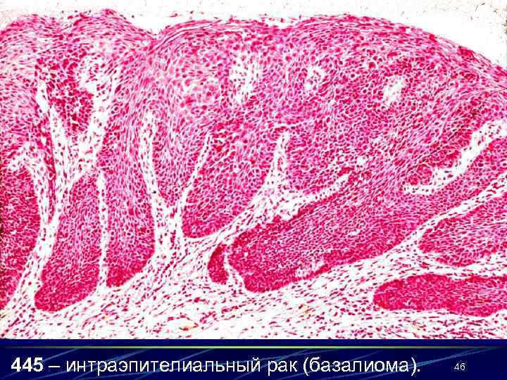 445 – интраэпителиальный рак (базалиома). 46 