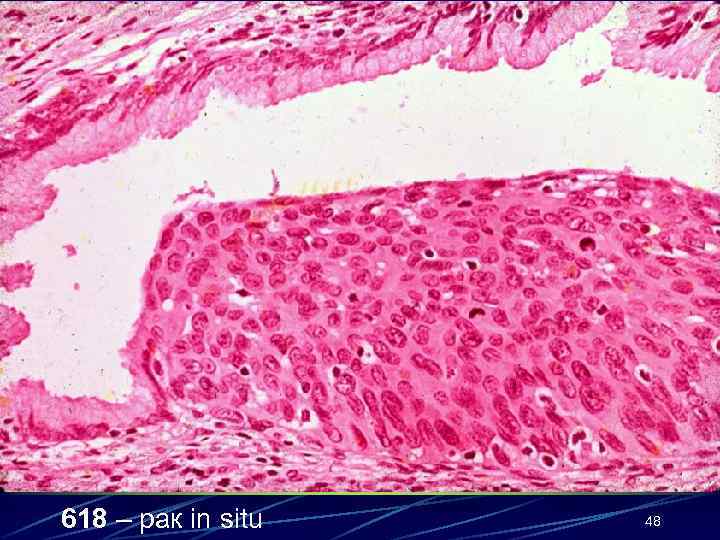 618 – рак in situ 48 