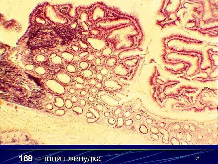 168 – полип желудка 51 
